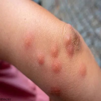 药物皮肤过敏怎么办 药物皮肤过敏的正确处理方法介绍