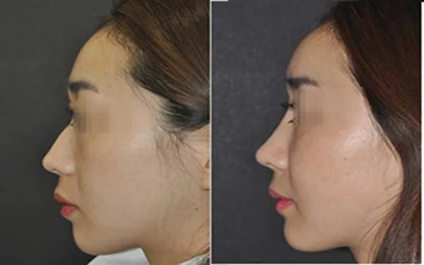 北京好的鼻部手术整形医院在哪