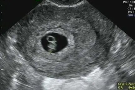 刚怀孕b超单图片