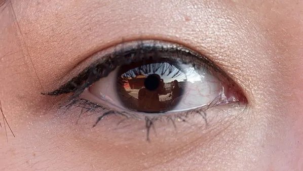 眼皮上脂肪粒怎么去除