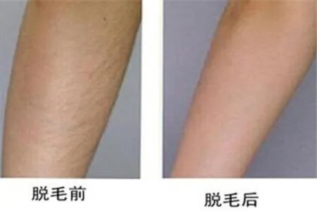 激光全身脱毛要多少钱