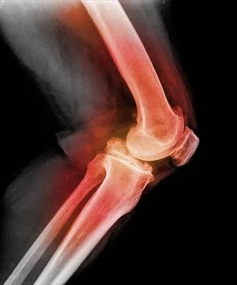 髌骨软化症怎样治疗