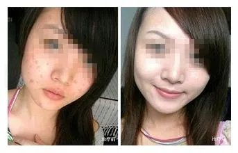 点阵激光多少钱一次