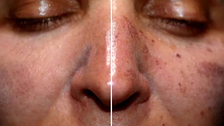 治疗黄褐斑简单偏方