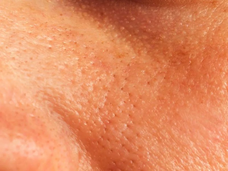 如何预防先天性红血丝