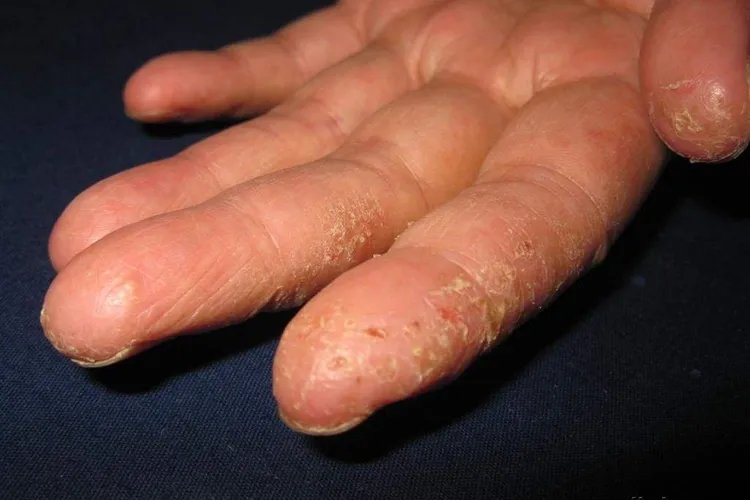 手上湿疹图片