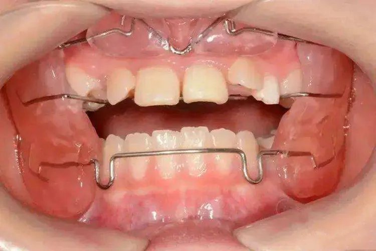 儿童牙齿矫正图片