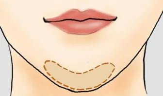假体隆下巴价格
