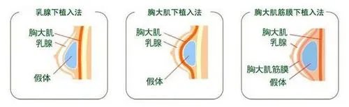 假体隆胸优势在哪里?