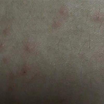 初生婴儿湿疹如何处理?