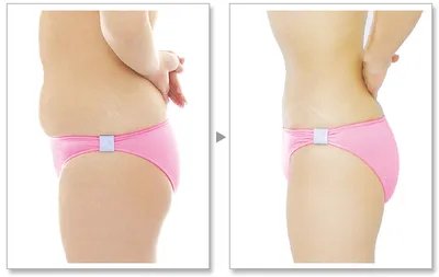 苏州吸脂手术医院哪家好？