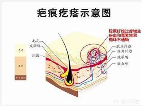 治愈疤痕疙瘩有哪些办法？