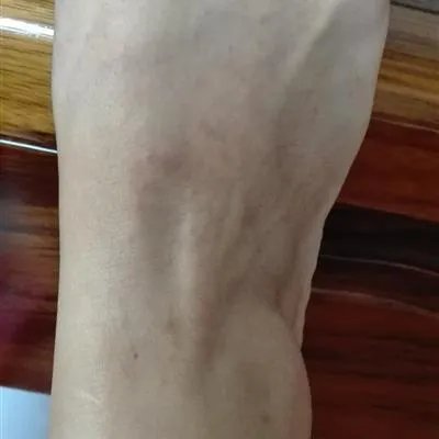 初生婴儿湿疹如何处理?