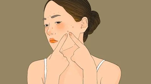 怎样除去青春痘