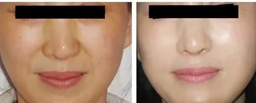 玻尿酸鼻唇沟填充价格是多少