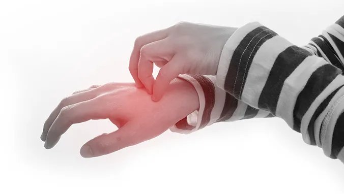 怎样治疗手部湿疹