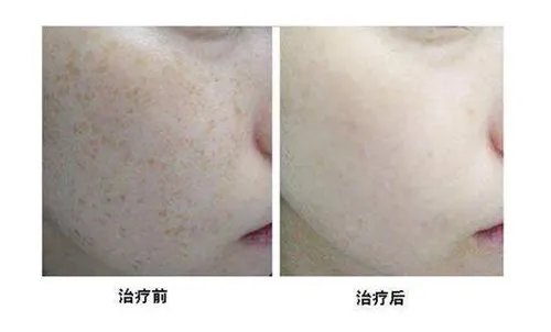 伊丽雪颜祛斑如何