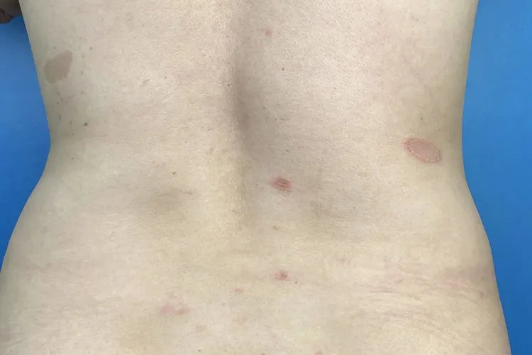 背上长圆圈癣图片