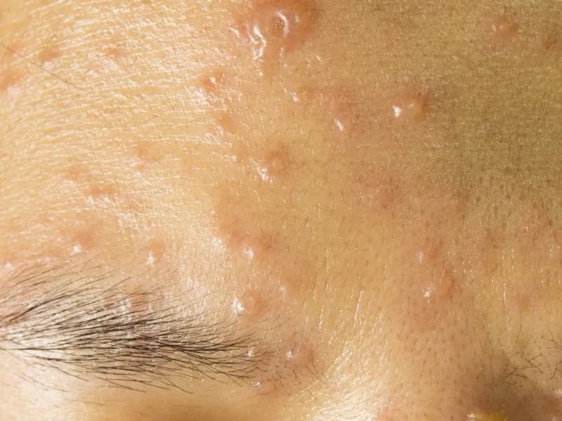 额头下巴长痘的原因