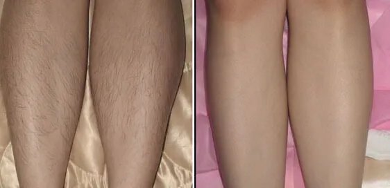 小腿激光脱毛价格多少