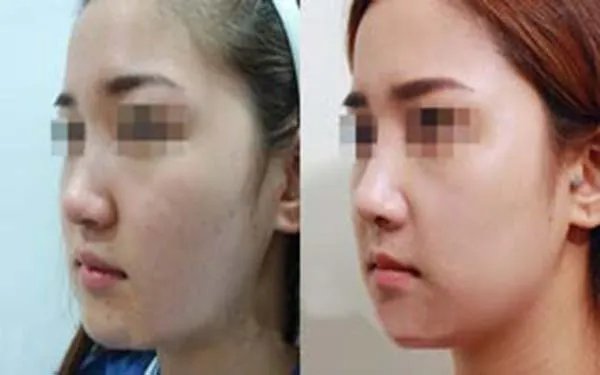 瑞兰隆鼻多少钱