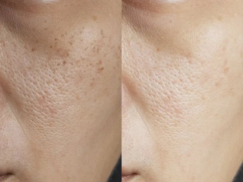 身上黄褐斑应该怎么处理