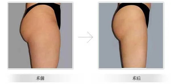 苏州吸脂手术医院哪家好？