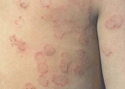 背上长圆圈癣图片