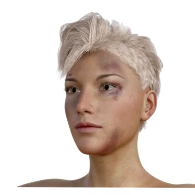 光子嫩肤去黑眼圈的原理    光子嫩肤去黑眼圈的注意事项