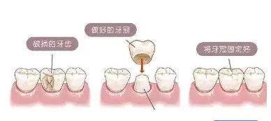 美容冠是什么？