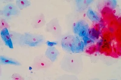 乔布斯长期对抗癌症