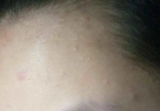 痤疮色斑的症状