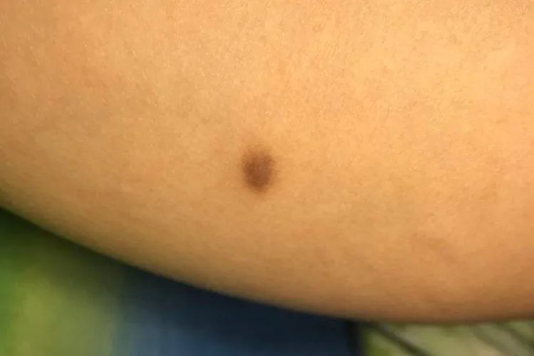 屁股上长了个褐色硬疙瘩图片