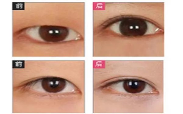 北京切开双眼皮哪个医院口碑好？