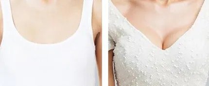 娜高假体隆胸价格是多少？