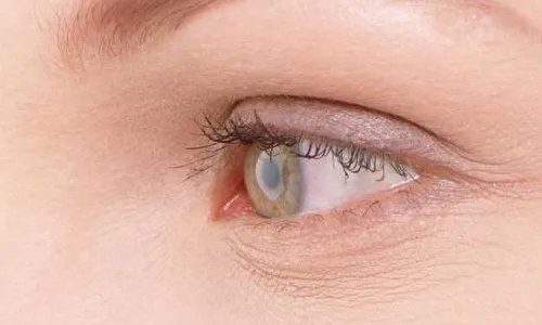 韩式开眼角适合人群