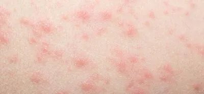 婴幼儿急疹出疹后如何护理