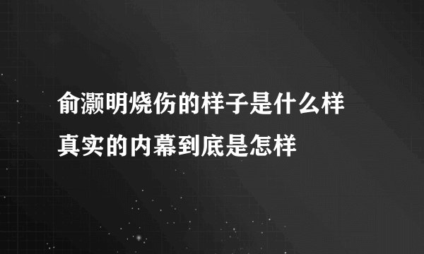 俞灏明烧伤的样子是什么样 真实的内幕到底是怎样