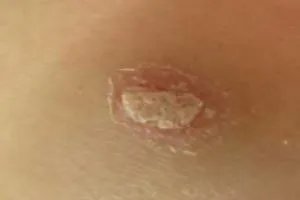 北京牛皮癣十大排名医院哪家见效快