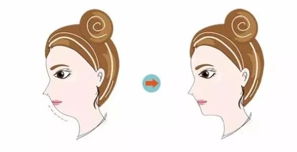 假体隆下巴价格