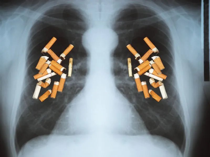 肺癌骨转移晚期症状