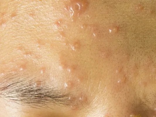 额头下巴长痘的原因