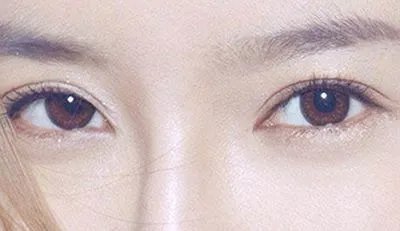 韩式开眼角整容需要多少钱