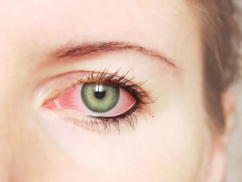 导致眼部黄褐斑的原因