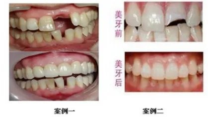 美容冠是什么？