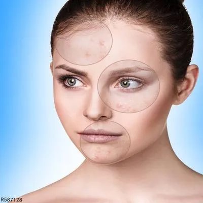 鼻翼两侧长痘怎么去除