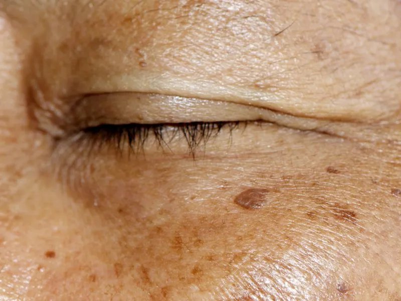 彩光去雀斑效果