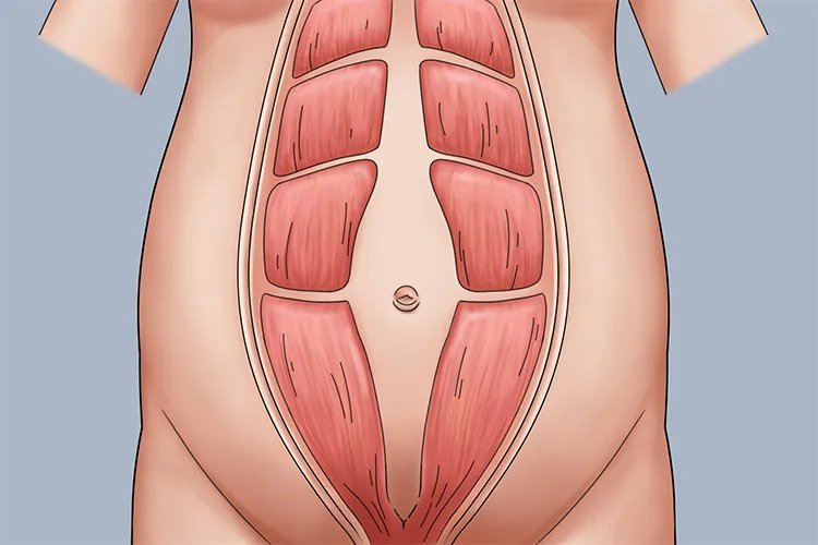 腹直肌分离是什么样子图片