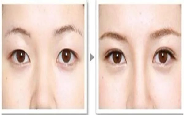 北京切开双眼皮哪个医院口碑好？