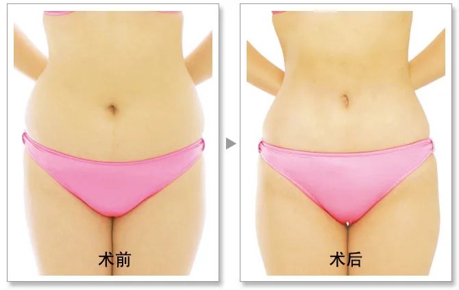 苏州吸脂手术医院哪家好？